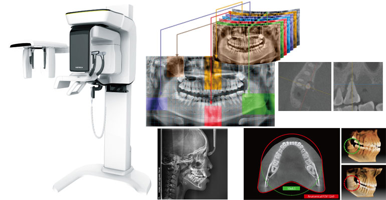 歯科用CTレントゲン