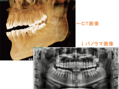 歯科用CTレントゲン